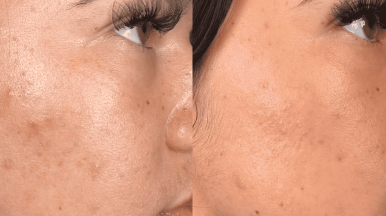 Close-up of facial skin with visible texture and pigmentation before treatment