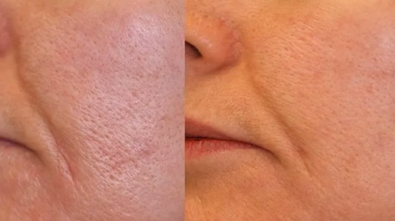 Detailed view of facial skin texture showing pores and uneven surface